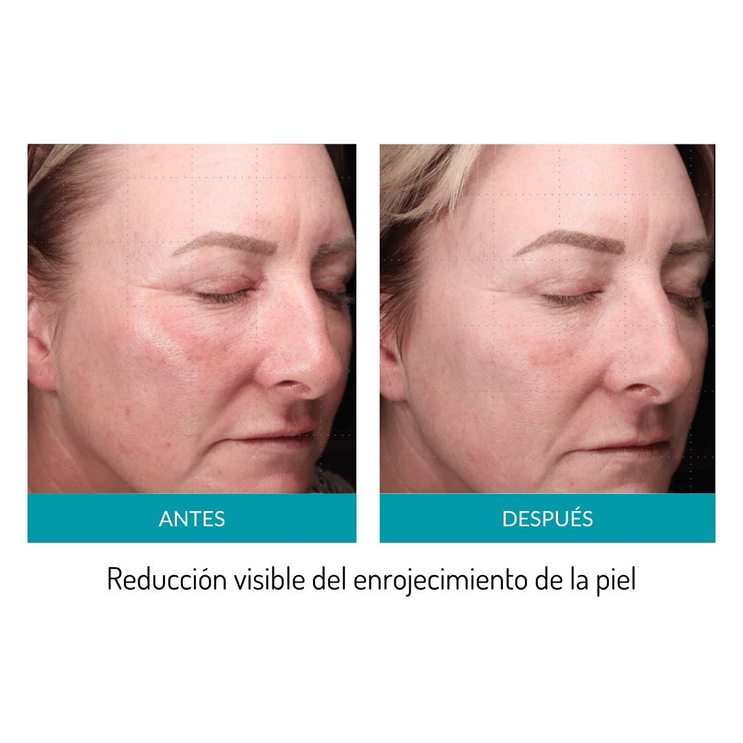 Glo Mask - Máscara antiedad de fototerapia LED de grado médico