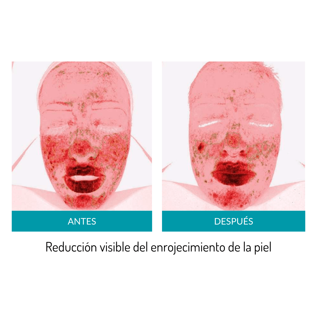 Glo Mask - Máscara antiedad de fototerapia LED de grado médico
