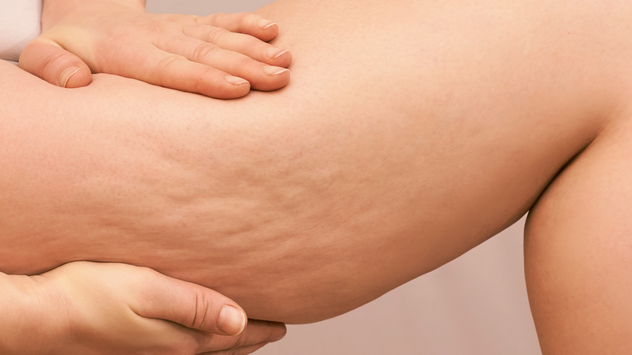 CONOCER Y ENTENDER LA FASCIA PARA COMBATIR LA CELULITIS